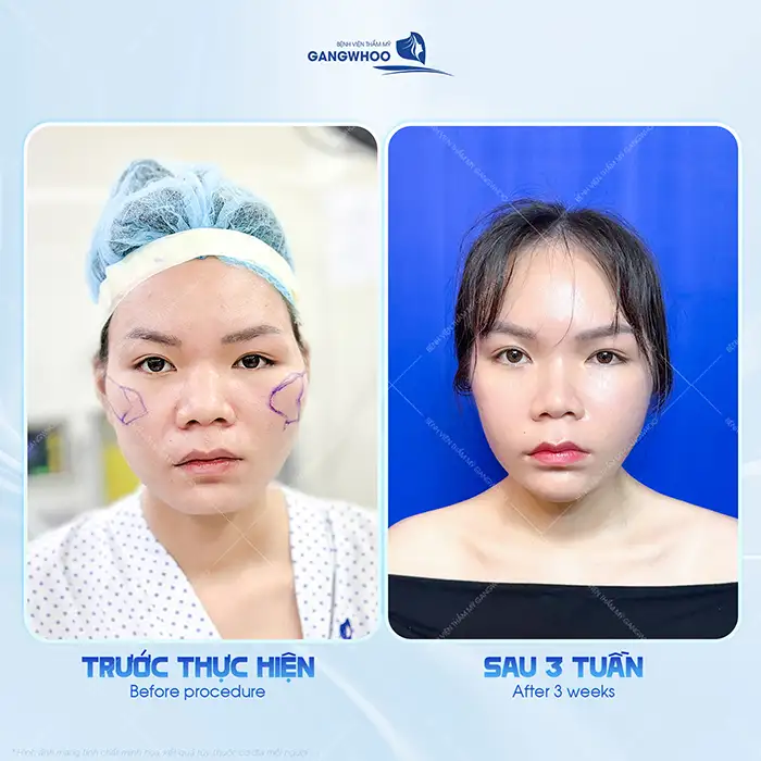 Hạ gò má có vĩnh viễn không? Thời gian duy trì sau khi hạ gò má