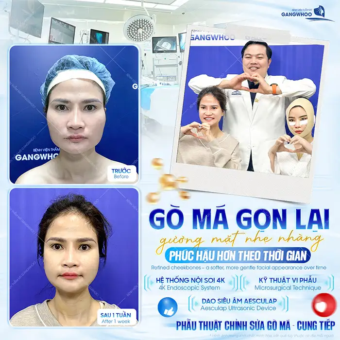 Hạ gò má có vĩnh viễn không? Thời gian duy trì sau khi hạ gò má