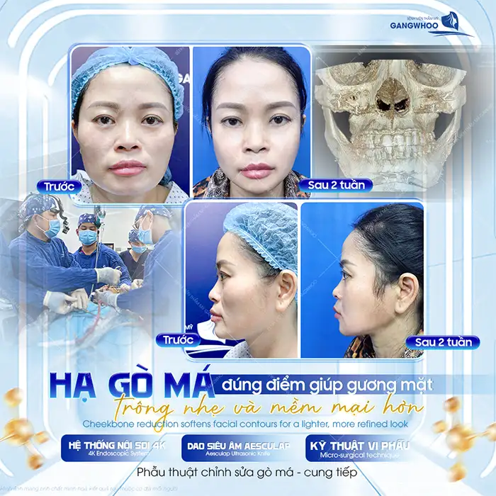 Hạ gò má có vĩnh viễn không? Thời gian duy trì sau khi hạ gò má