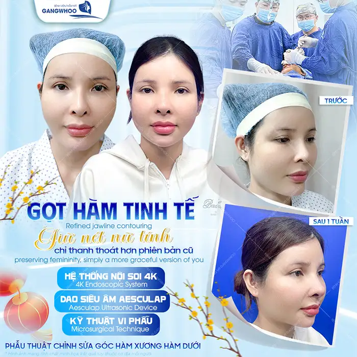 Hạ gò má giá bao nhiêu tiền? Chi phí hạ gò má cập nhật mới 2025