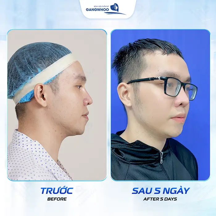 Có nên hạ gò má cho nam giới không? Ưu điểm và đối tượng phù hợp