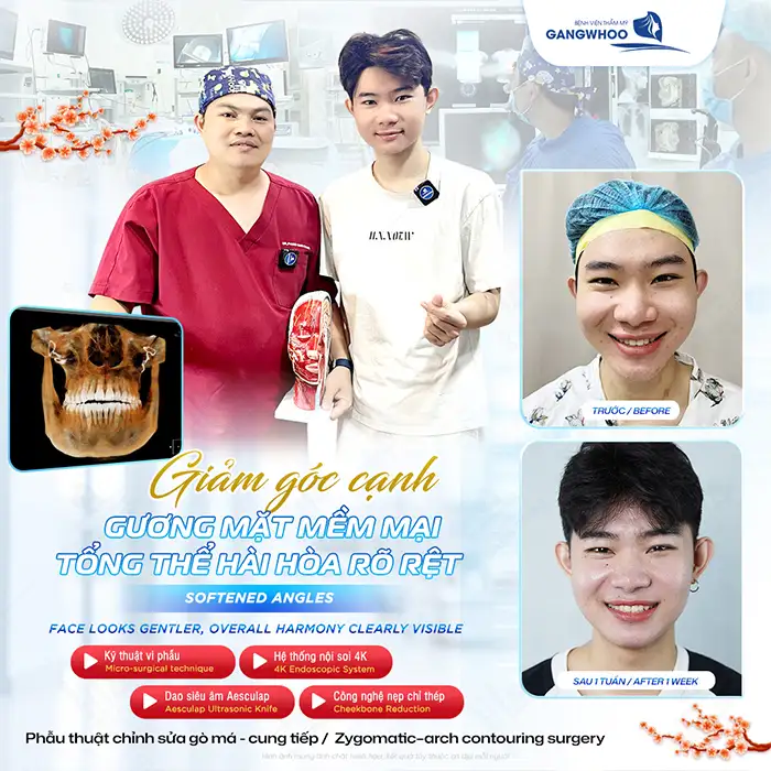 Có nên hạ gò má cho nam giới không? Ưu điểm và đối tượng phù hợp