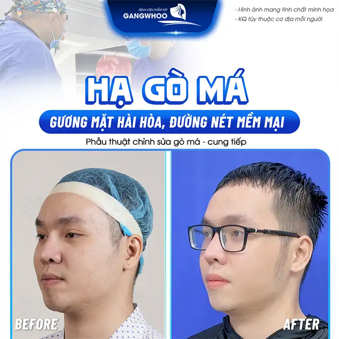 Có nên hạ gò má cho nam giới không? Ưu điểm và đối tượng phù hợp