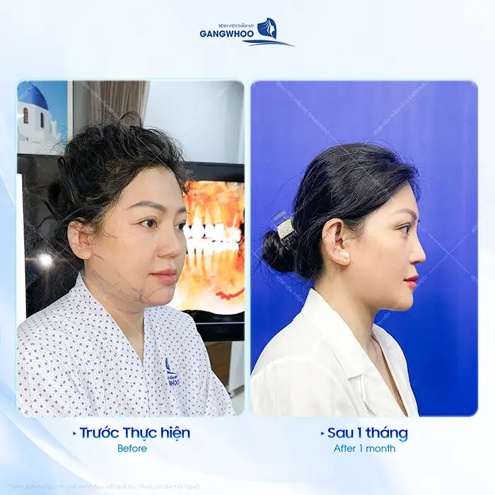 Hạ gò má ở đâu đẹp và an toàn? Tham khảo 5+ đia chỉ uy tín