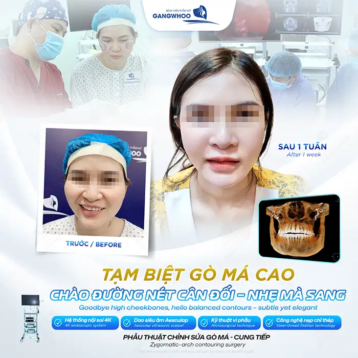 Hạ gò má ở đâu đẹp và an toàn? Tham khảo 5+ đia chỉ uy tín