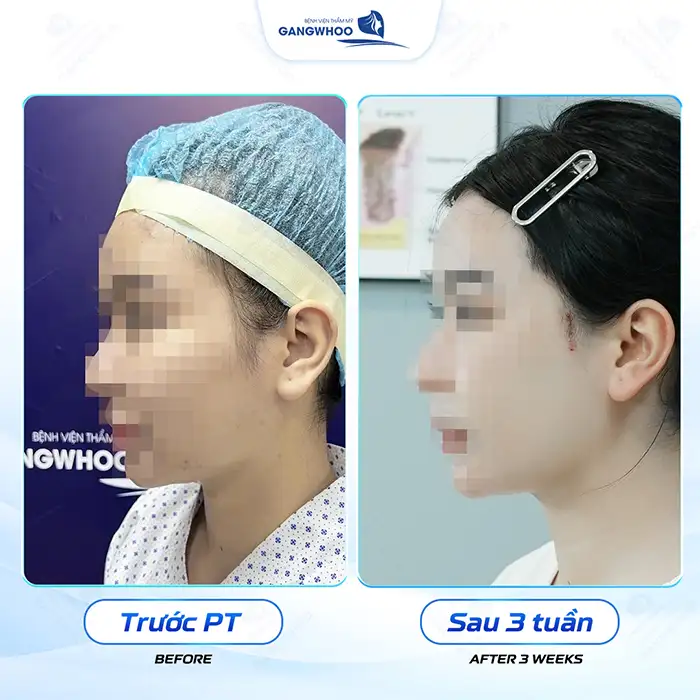 Hạ gò má ở đâu đẹp và an toàn? Tham khảo 5+ đia chỉ uy tín