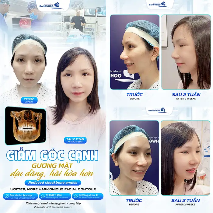 Hạ gò má trả góp ở đâu uy tín? Điều kiện và lãi suất ra sao?