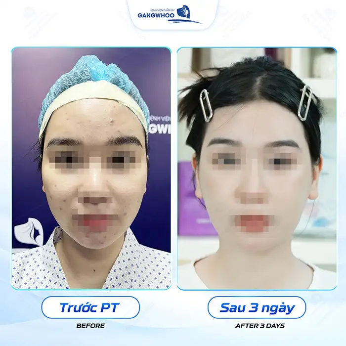 Hạ gò má trả góp ở đâu uy tín? Điều kiện và lãi suất ra sao?