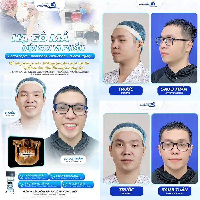 Hạ gò má trả góp ở đâu uy tín? Điều kiện và lãi suất ra sao?