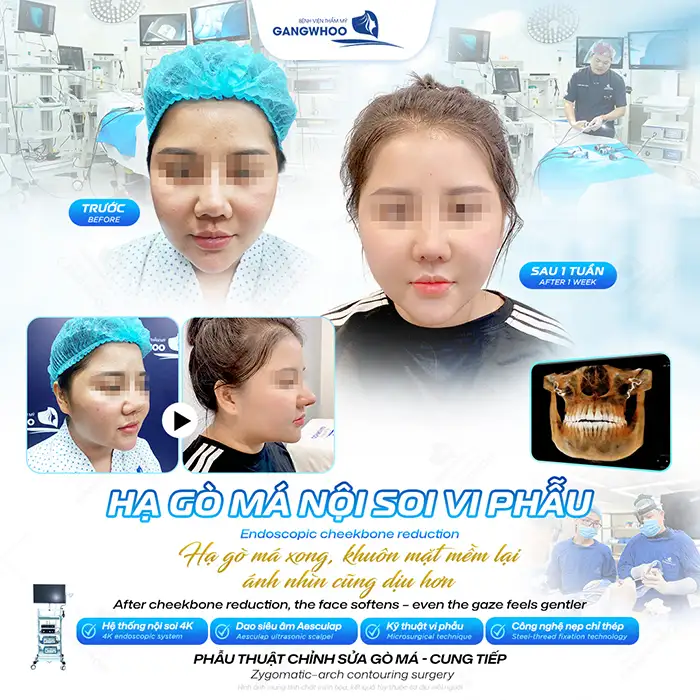 Hạ gò má trả góp ở đâu uy tín? Điều kiện và lãi suất ra sao?