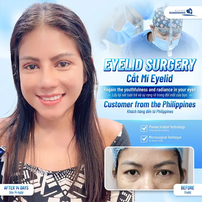 Mắt mí lót có nên cắt mí không? Nên lưu ý an toàn trước khi cắt mí