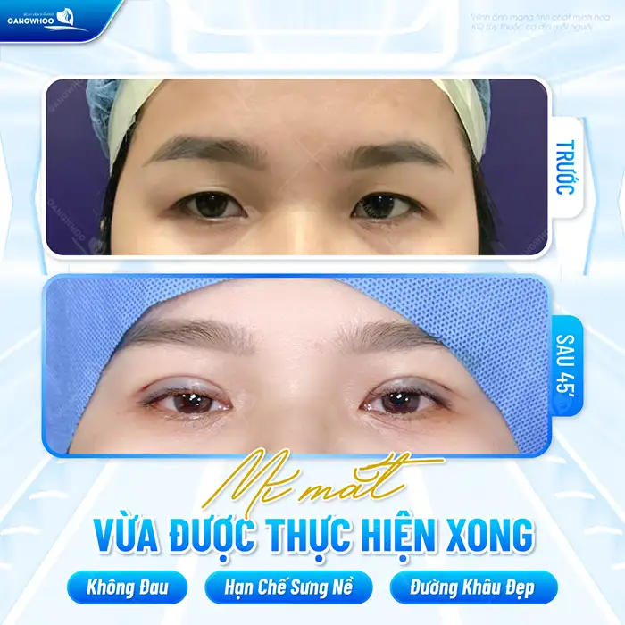 Mắt mí lót có nên cắt mí không? Nên lưu ý an toàn trước khi cắt mí