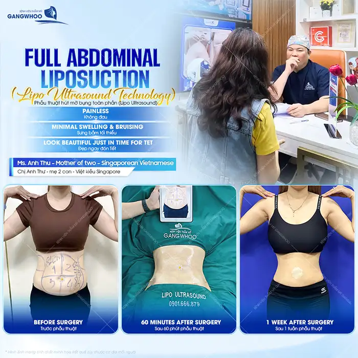 Hút mỡ bằng sóng siêu âm là gì? Có an toàn và hiệu quả không?