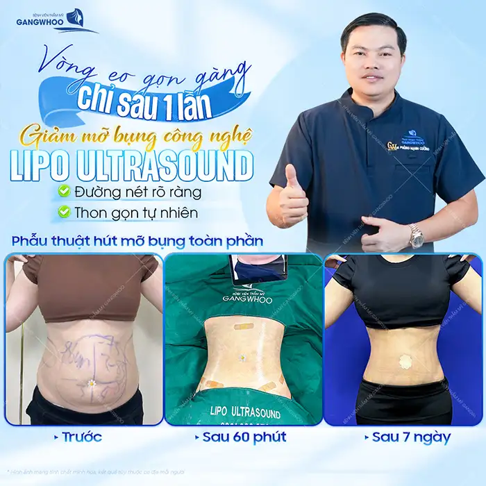 Hút mỡ bằng sóng siêu âm là gì? Có an toàn và hiệu quả không?