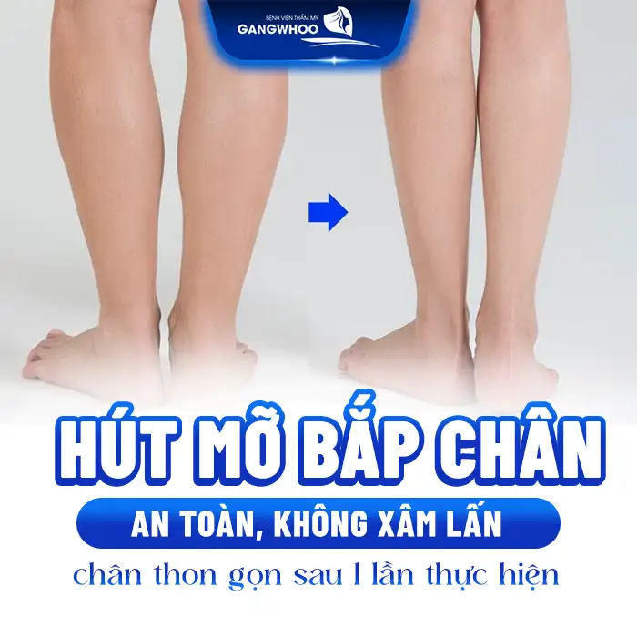 Hút mỡ bắp chân có nguy hiểm không? Những lưu ý trước khi thực hiện