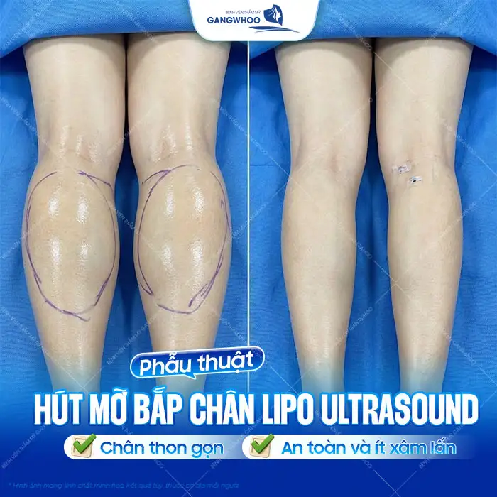 Hút mỡ bắp chân giá bao nhiêu tiền? Cập nhật chi phí mới nhất 2025