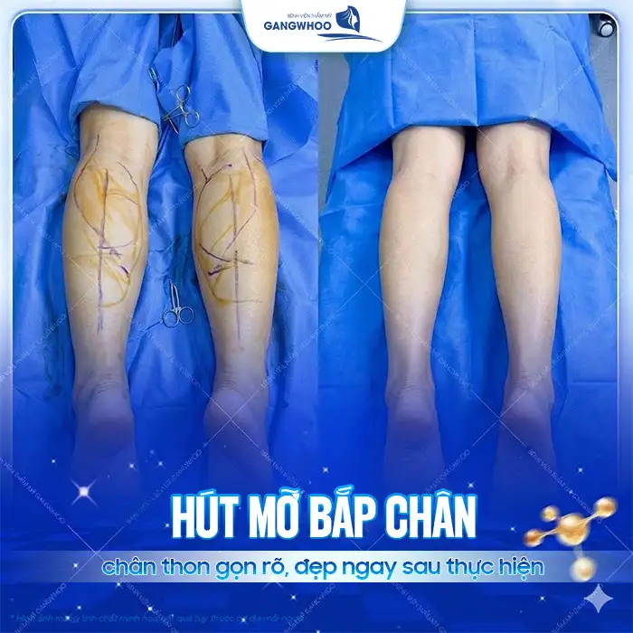 Hút mỡ bắp chân giá bao nhiêu tiền? Cập nhật chi phí mới nhất 2025