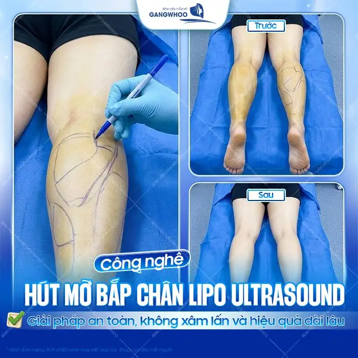 Hút mỡ bắp chân giá bao nhiêu tiền? Cập nhật chi phí mới nhất 2025