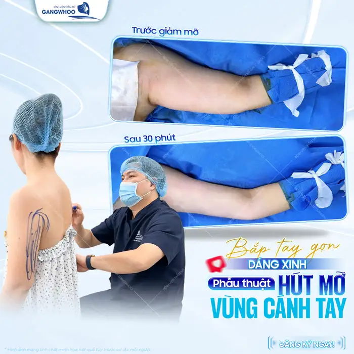 Hút mỡ bắp tay bao lâu lành? Thời gian hồi phục chuẩn y khoa