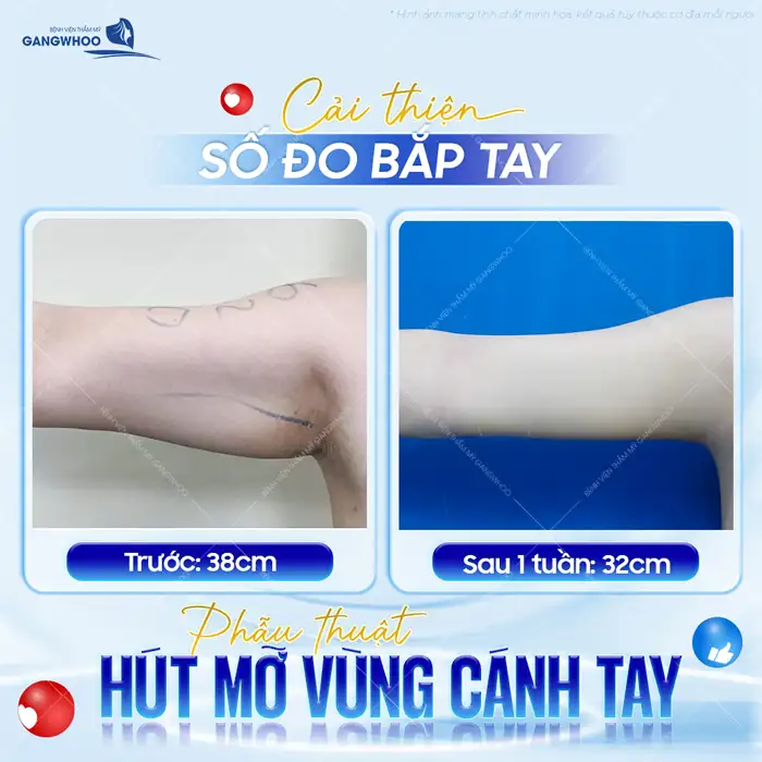 Hút mỡ bắp tay bao lâu lành? Thời gian hồi phục chuẩn y khoa
