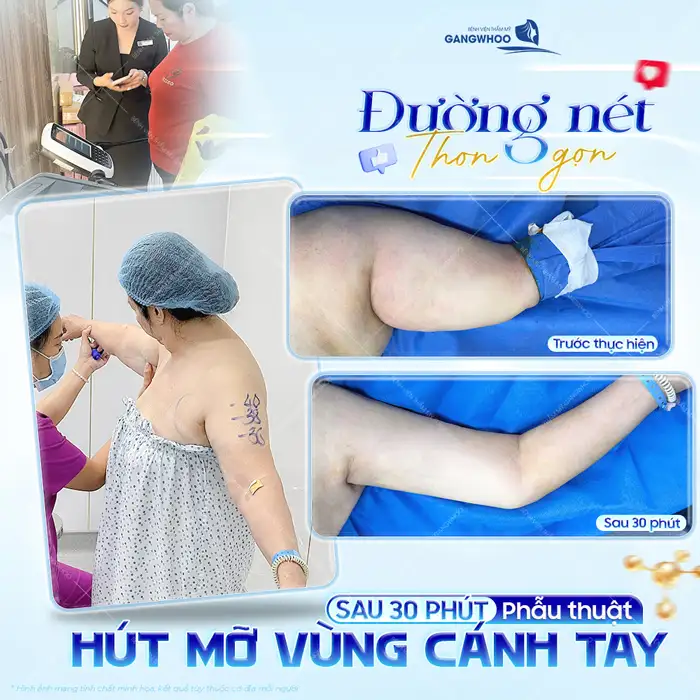 Hút mỡ bắp tay bao lâu lành? Thời gian hồi phục chuẩn y khoa