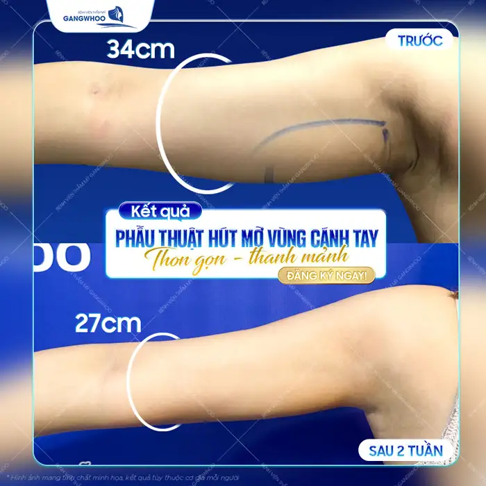 Hút mỡ bắp tay bao lâu lành? Thời gian hồi phục chuẩn y khoa