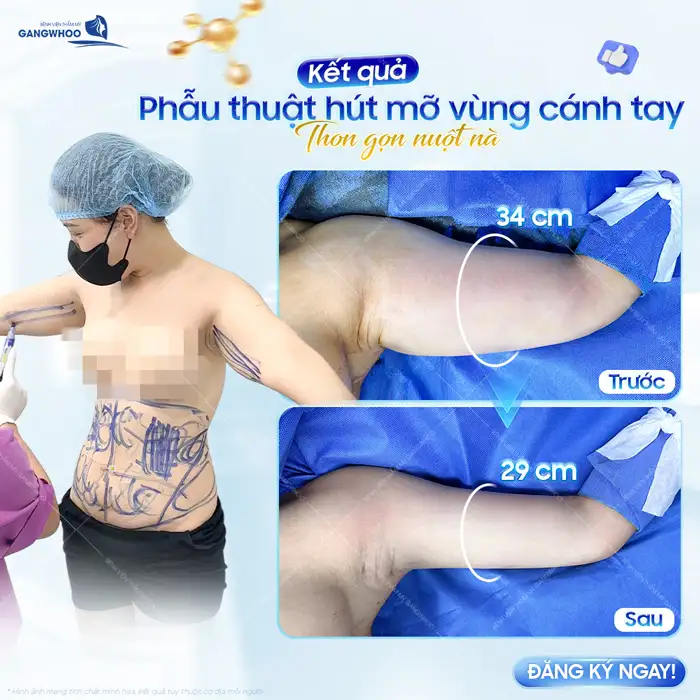 Hút mỡ bắp tay có nguy hiểm không? Bác sĩ giải đáp chi tiết