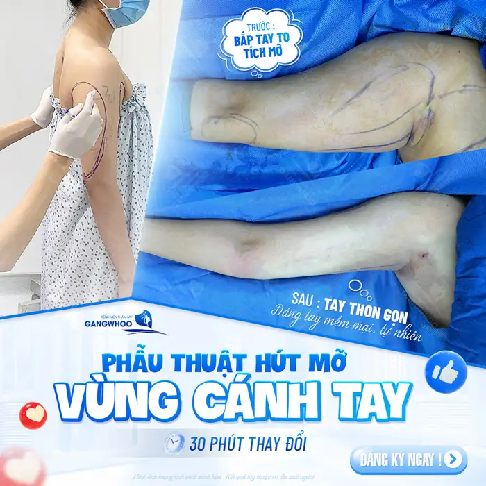 Hút mỡ bắp tay có nguy hiểm không? Bác sĩ giải đáp chi tiết