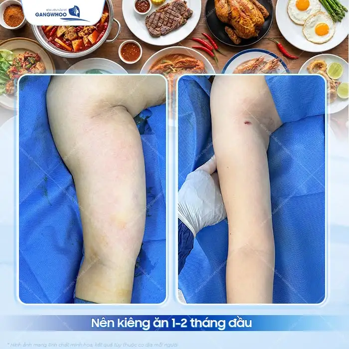 Hút mỡ bắp tay kiêng ăn gì để nhanh lành và hồi phục tốt hơn