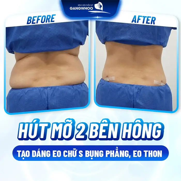 Hút mỡ 2 bên hông là gì? Có nên lựa chọn hút mỡ vùng hông