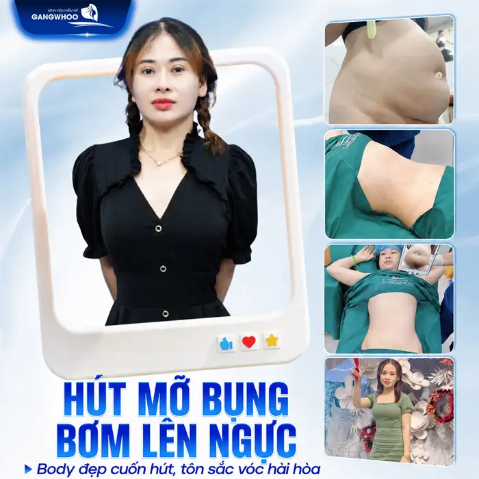 Phương pháp hút mỡ bụng bơm lên ngực có an toàn, hiệu quả không?
