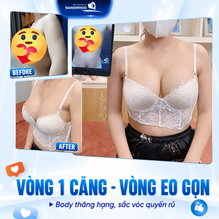 Phương pháp hút mỡ bụng bơm lên ngực có an toàn, hiệu quả không?