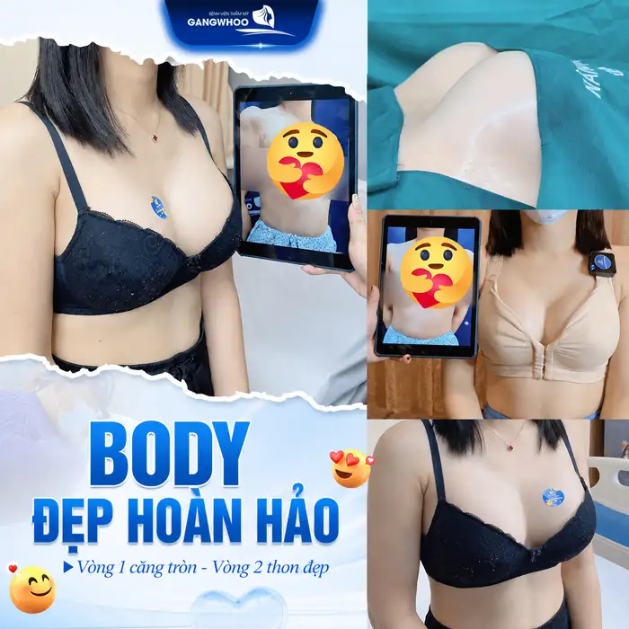 Phương pháp hút mỡ bụng bơm lên ngực có an toàn, hiệu quả không?