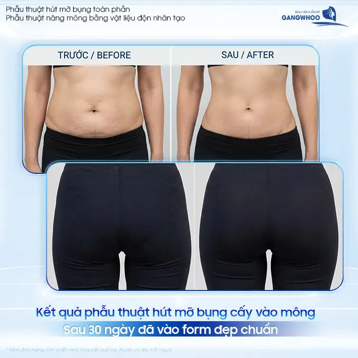 Hút mỡ bụng cấy mông có an toàn không? Có duy trì được lâu dài không?