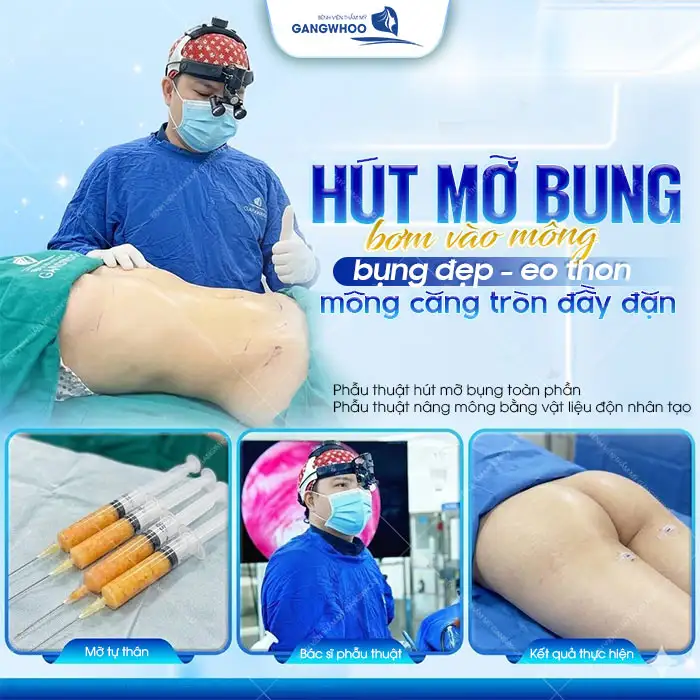 Hút mỡ bụng cấy mông có an toàn không? Có duy trì được lâu dài không?