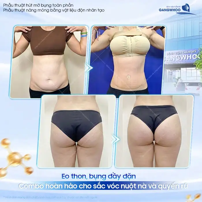 Hút mỡ bụng cấy mông có an toàn không? Có duy trì được lâu dài không?