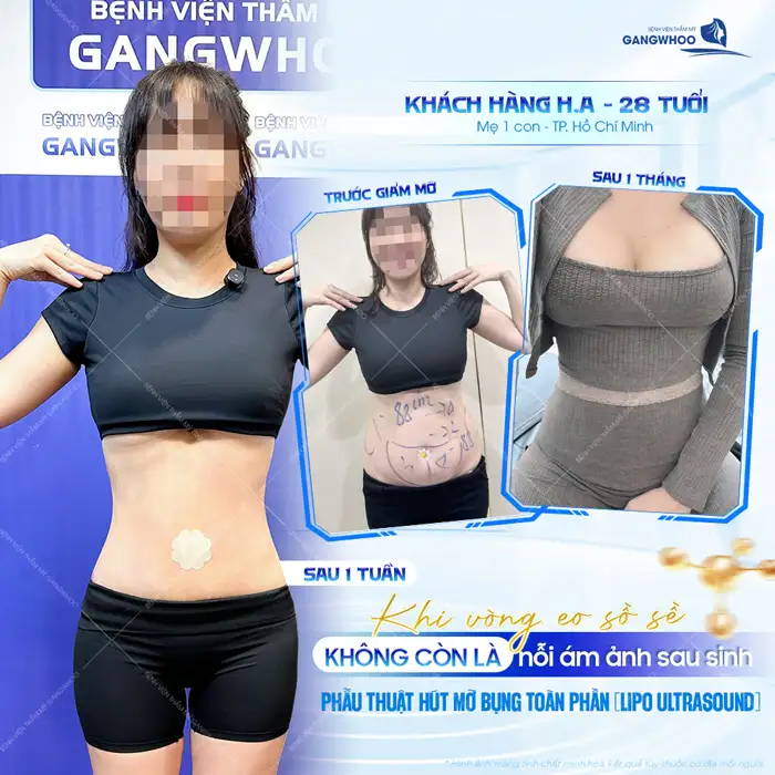 Hút mỡ có béo lại không? Nguyên nhân và cách phòng tránh