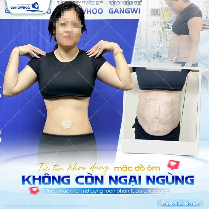 Hút mỡ có béo lại không? Nguyên nhân và cách phòng tránh