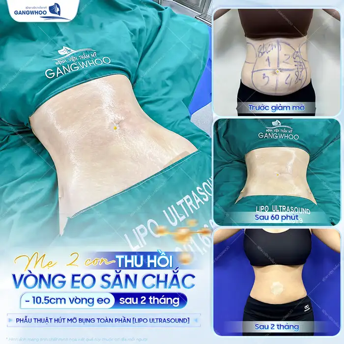Hút mỡ bụng có để lại sẹo không? Cách làm mờ sẹo sau hút mỡ bụng