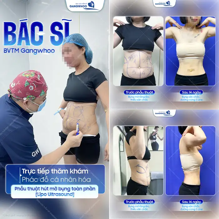 Hút mỡ bụng có để lại sẹo không? Cách làm mờ sẹo sau hút mỡ bụng