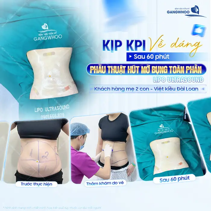 Hút mỡ bụng có để lại sẹo không? Cách làm mờ sẹo sau hút mỡ bụng