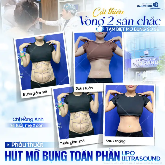 Hút mỡ bụng không phẫu thuật là gì? Có mang lại hiệu quả cao không?