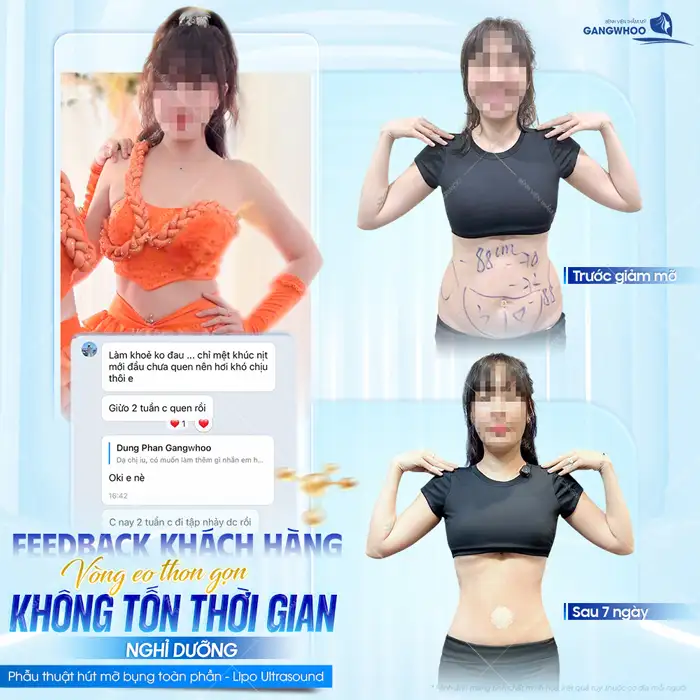 Hút mỡ bụng không phẫu thuật là gì? Có mang lại hiệu quả cao không?