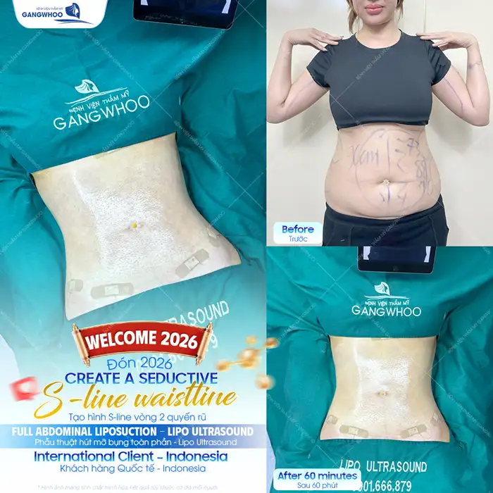 Hút mỡ bụng không phẫu thuật là gì? Có mang lại hiệu quả cao không?