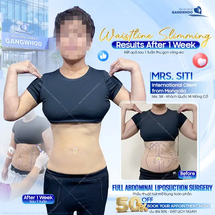 Hút mỡ bụng ở Hà Nội ở đâu tốt? Top 5+ địa chỉ uy tín, an toàn