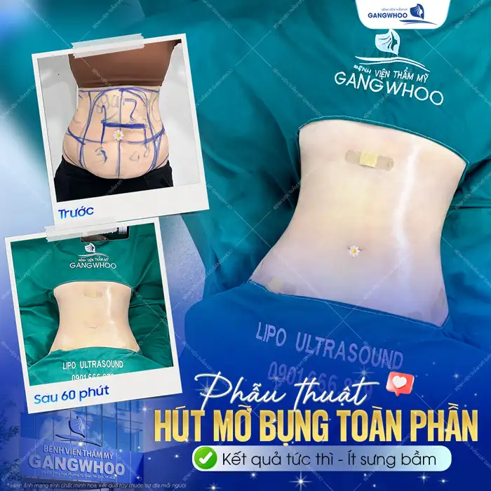 Hút mỡ bụng ở Hà Nội ở đâu tốt? Top 5+ địa chỉ uy tín, an toàn