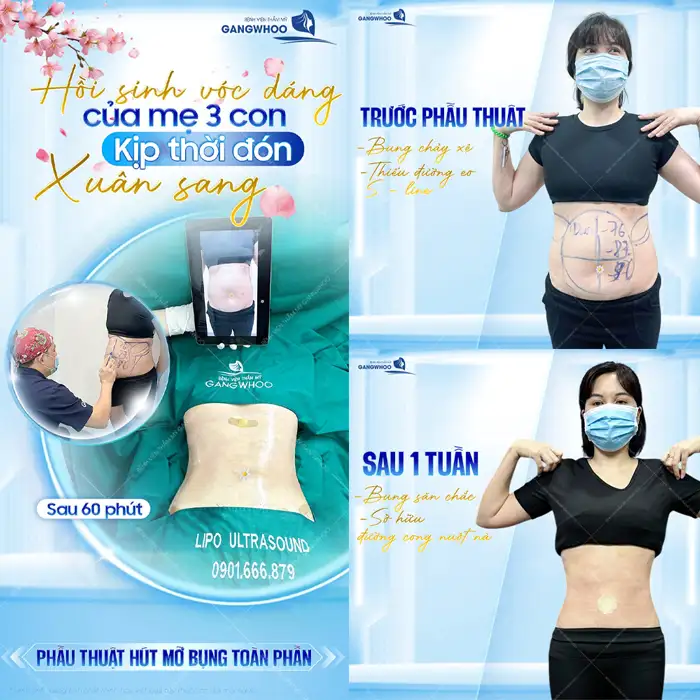 Hút mỡ bụng ở Hà Nội ở đâu tốt? Top 5+ địa chỉ uy tín, an toàn