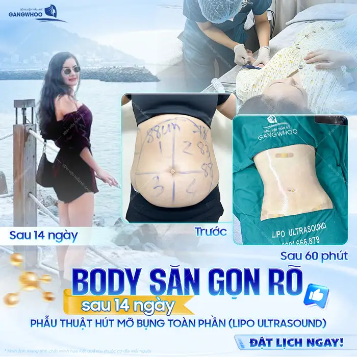 Hút mỡ bụng ở Hà Nội ở đâu tốt? Top 5+ địa chỉ uy tín, an toàn