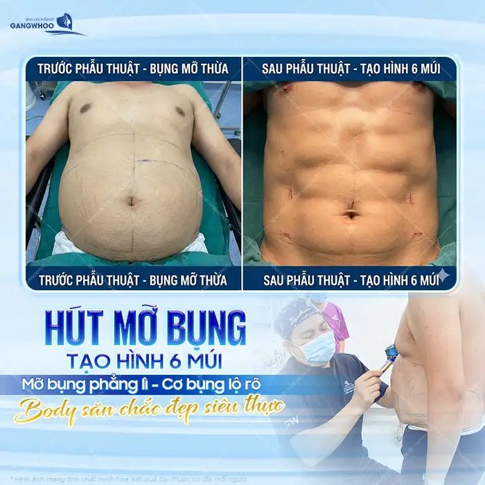 Hút mỡ bụng tạo hình 6 múi có hiệu quả không? Những ai nên thực hiện