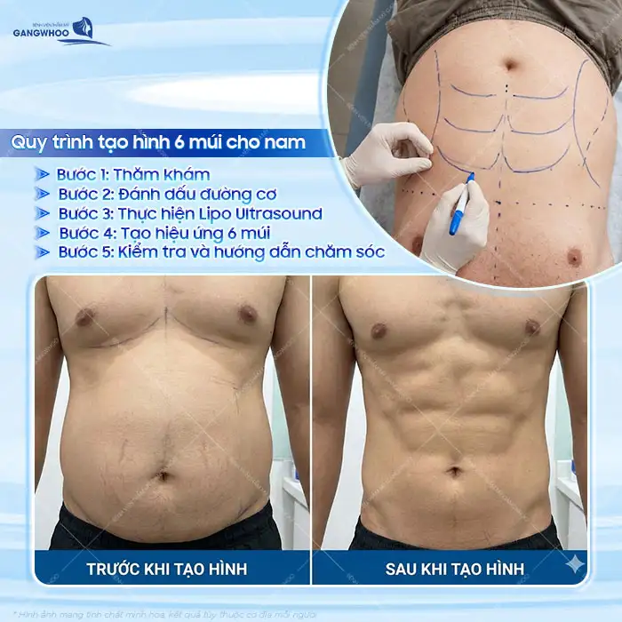 Hút mỡ bụng tạo hình 6 múi có hiệu quả không? Những ai nên thực hiện